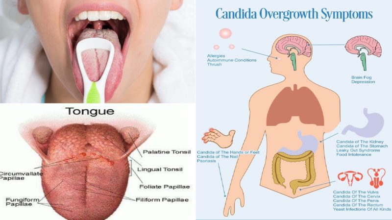 Candida Overgrowth In Your Body Causes And Symptoms Top Natural Remedy 