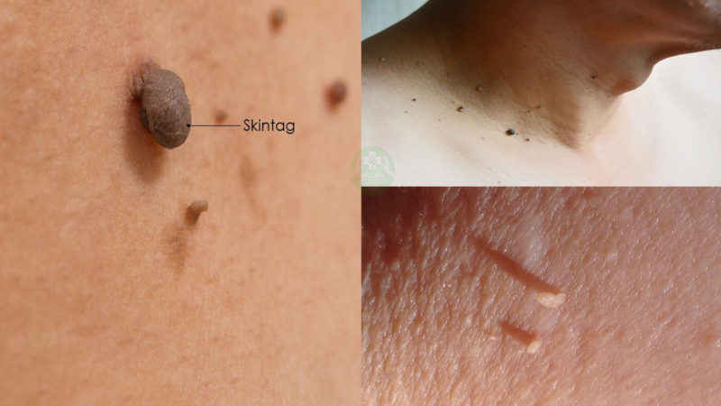 Best Thing For Skin Tags